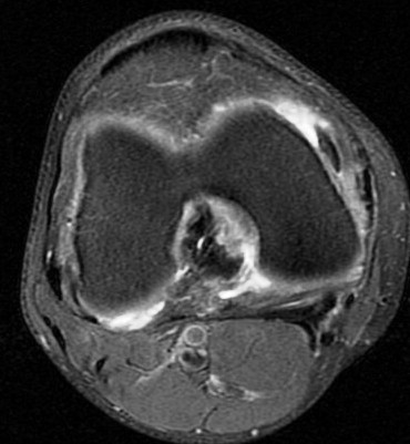 Figure 5 for case Unstable flap tear, medial meniscus